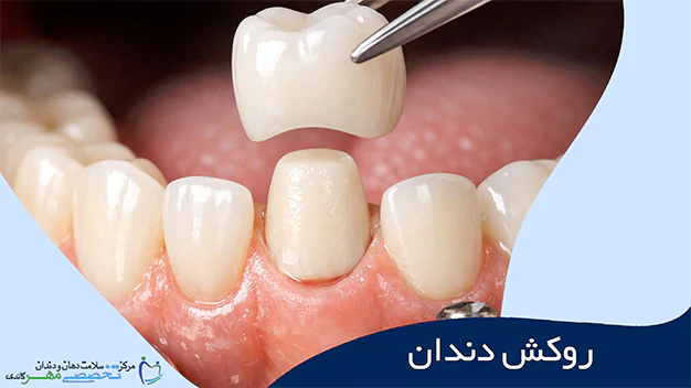 روکش دندان چیست؟