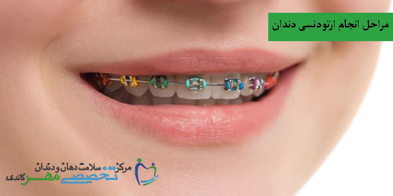 مراحل انجام ارتودنسی دندان