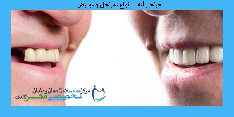جراحی لثه + انواع، مراحل و عوارض