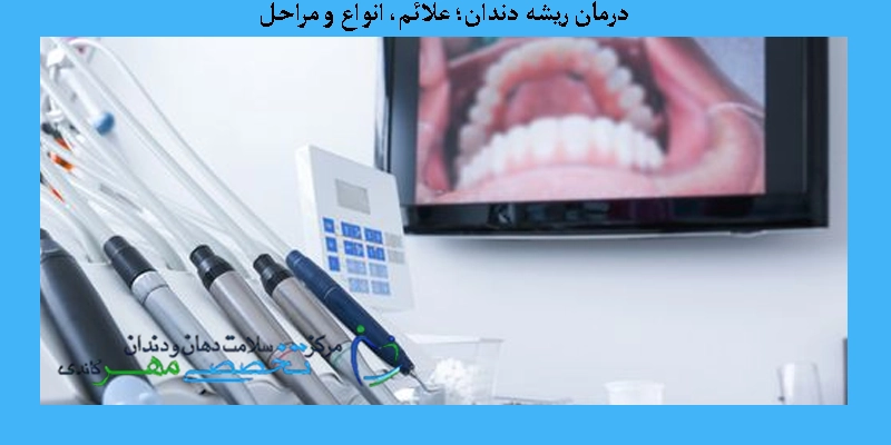 درمان ریشه دندان؛ علائم، انواع و مراحل