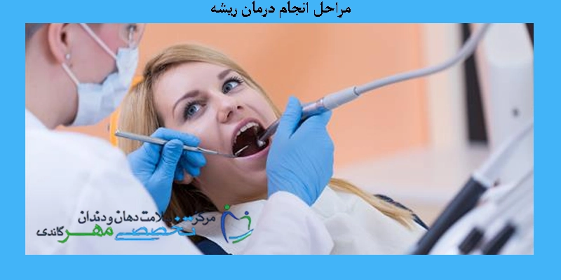 مراحل انجام درمان ریشه