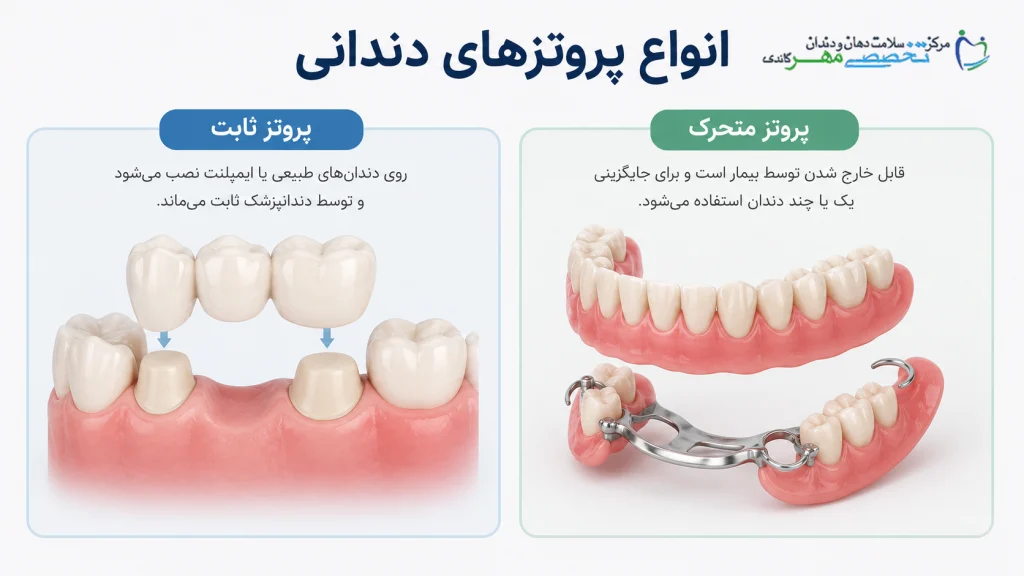 انواع پروتزهای دندانی