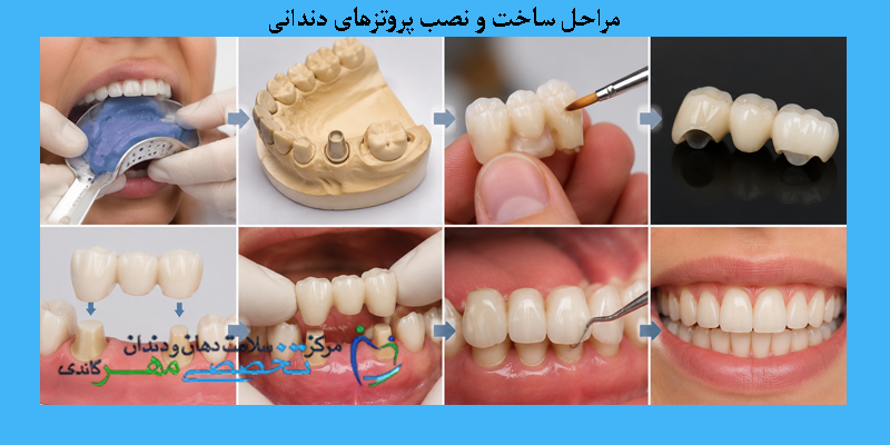 مراحل ساخت و نصب پروتزهای دندانی