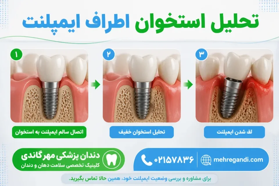 تحلیل استخوان اطراف ایمپلنت — مقایسه اتصال سالم ایمپلنت با تحلیل استخوان و لق شدن پایه ایمپلنت
