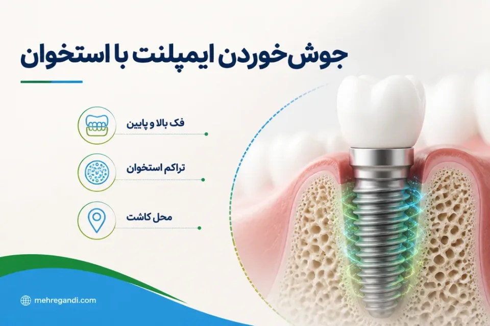 جوشخوردن ایمپلنت با استخوان